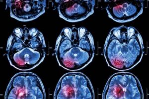 Brain cancer can be cured if it's detected early.