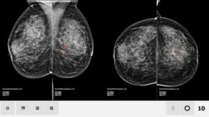 AI is Enhancing Accuracy in Cancer Diagnosis & Radiology