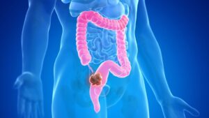 Understanding Colorectal Cancer: Myths, Facts & Prevention
